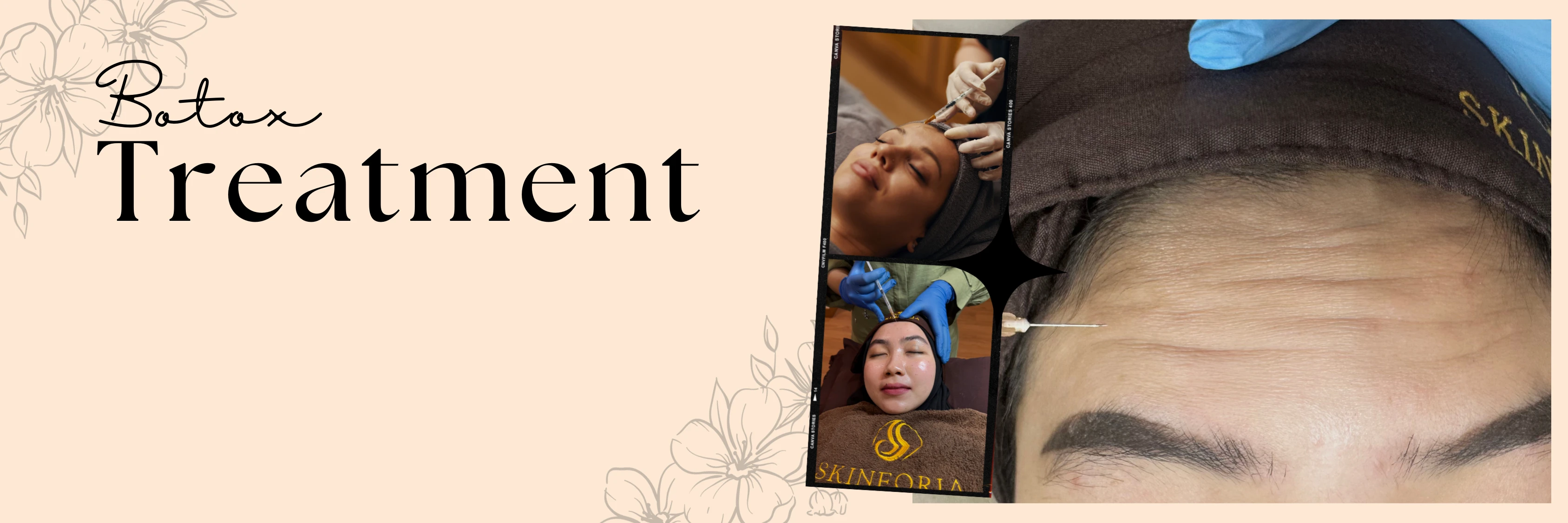 banner-treatment